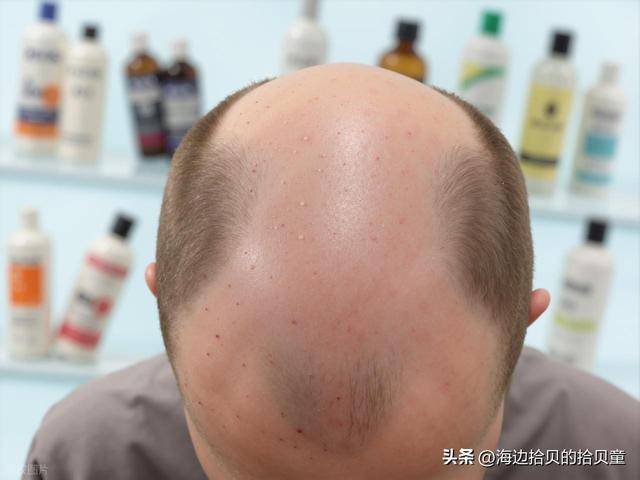 霸王育发液有用吗真的能生发吗?优选生发液第一名正牌!(图4)