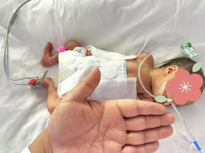 生命奇迹！泗洪124公斤“掌心宝宝”历经29天顺利闯关……(图2)