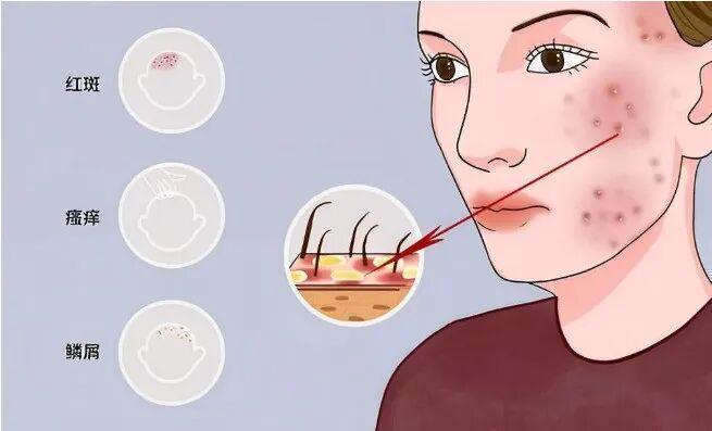 为什么用去屑洗发水头皮屑反而越洗越多？(图11)