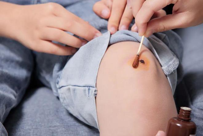 一字之差天差地别！碘伏和碘酒别乱用